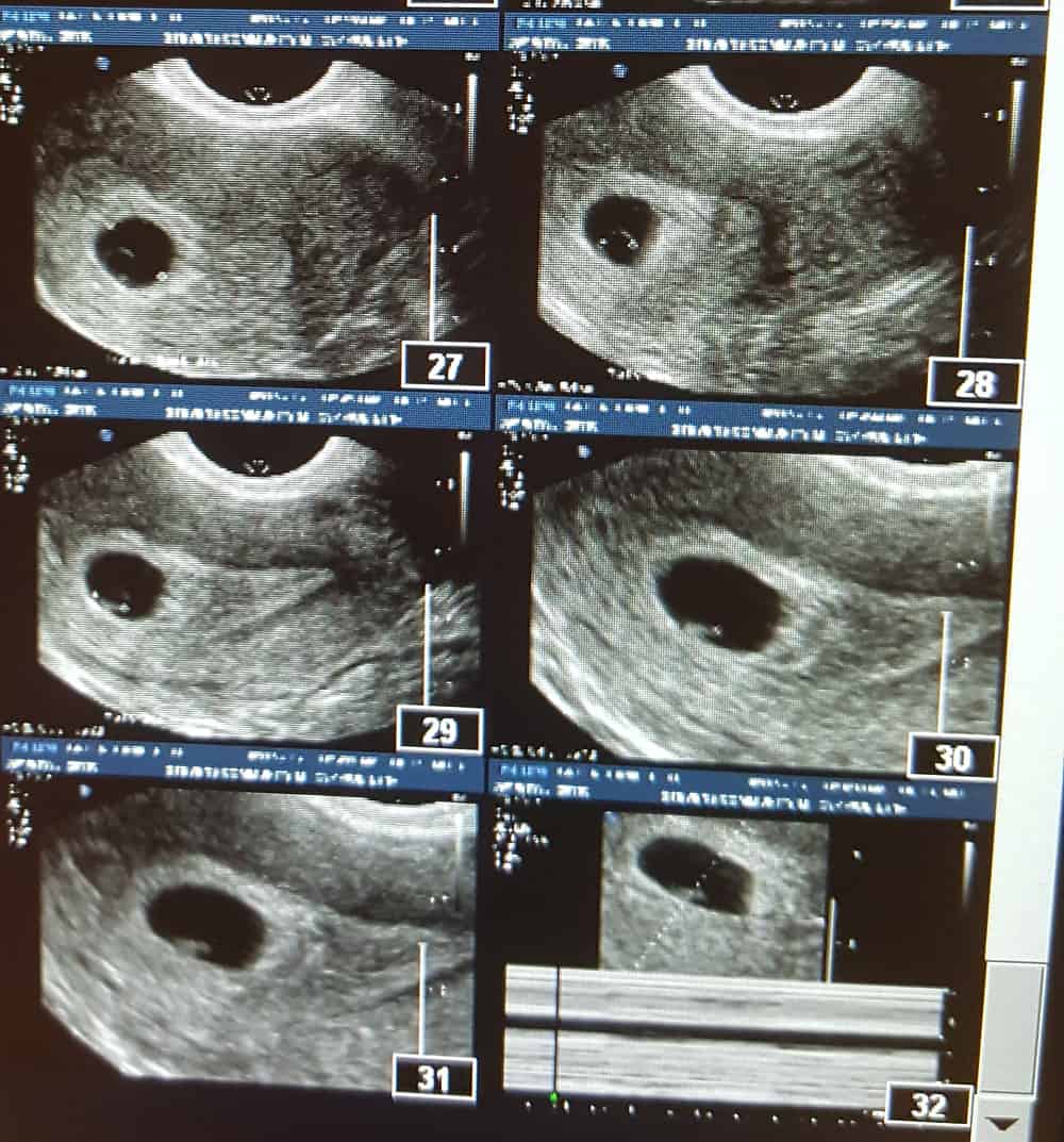 My IVF Journey - Infertility